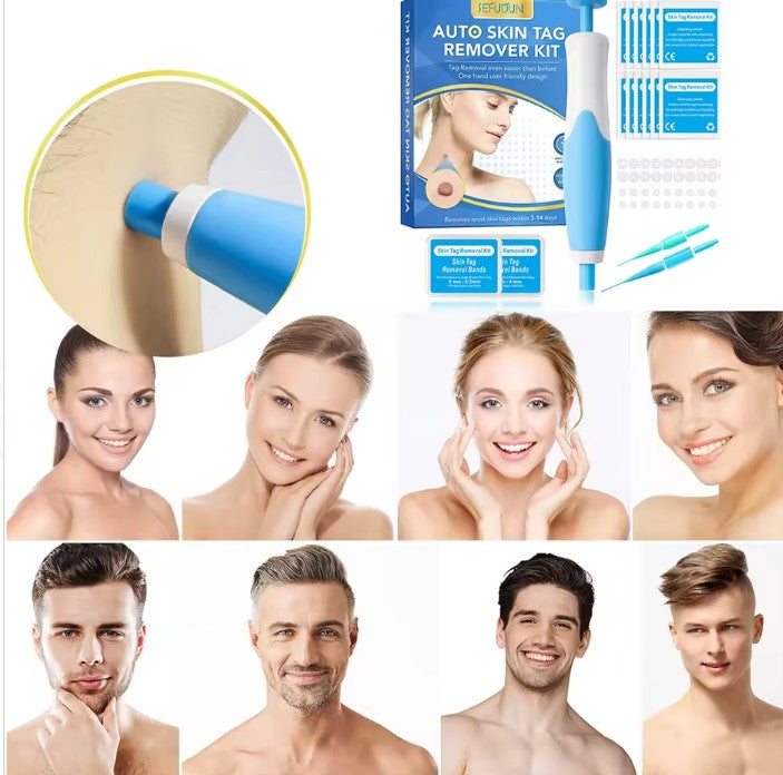 Rubber rings skin tag removal